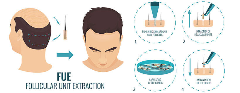 Illustration demonstrating the FUE (Follicular Unit Extraction) Hair Transplants process for educational purposes