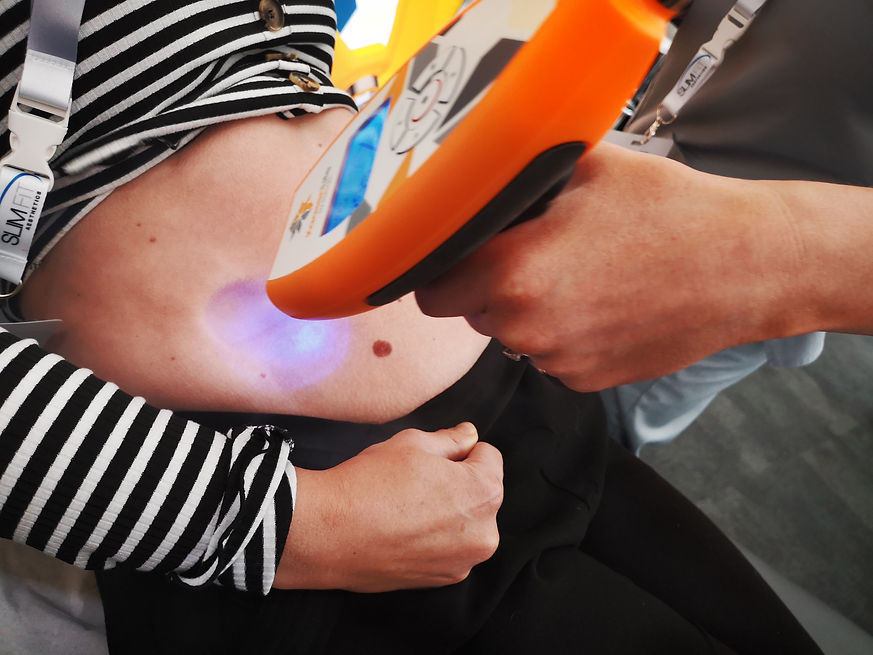 CRYO ABDOMEN 2.jpeg
