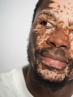 Gros plan sur le visage d’un modèle homme porteur de vitiligo, photographié en studio à Gentilly près de Paris. Ce type de cadrage met en valeur les textures de peau et l’unicité du modèle, idéal pour book comédien ou projet artistique. Le studio Colombe Photographie accompagne les talents en région parisienne.
