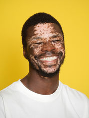 Portrait artistique d’un modèle homme porteur de vitiligo sur fond jaune en studio à Gentilly, près de Paris. Une image expressive et moderne idéale pour un book mannequin ou comédien en Île-de-France. Le studio Colombe Photographie propose des shootings créatifs pour valoriser la personnalité et l’image professionnelle.