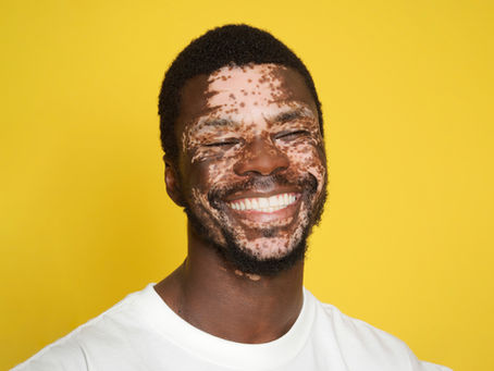Portrait artistique d’un modèle homme porteur de vitiligo sur fond jaune en studio à Gentilly, près de Paris. Une image expressive et moderne idéale pour un book mannequin ou comédien en Île-de-France. Le studio Colombe Photographie propose des shootings créatifs pour valoriser la personnalité et l’image professionnelle.