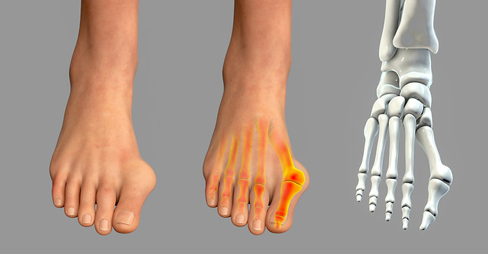 Hallux Valgus Schritt für Schritt zum Schmerz.jpeg