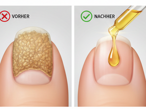 Ein hartnäckiger Nagelpilz - was kann ich tun?
