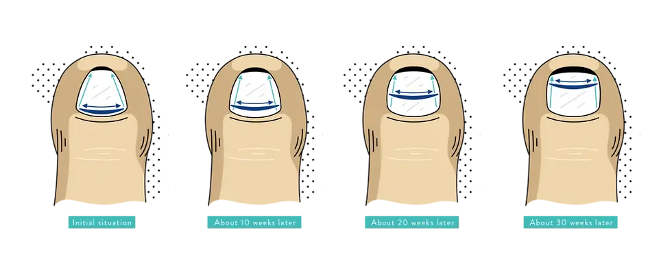 ingrown-toenail-brace-1080x405.webp