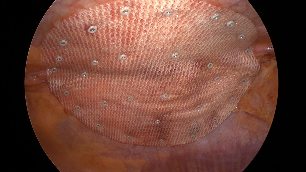 The Safety Net: Understanding the Role of Surgical Mesh in Hernia Repair