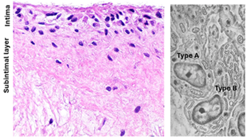 Fig. K22. Light and electron microscopic features of the synovial membrane. The H&E-stained section (left) shows the highly cellular intimal layer of the synovial membrane and the subintimal layer of loose connective tissue. The electron micrograph (right) shows a type A synoviocytes containing lysosomes and a type B synoviocytes showing numerous rER cisternae.