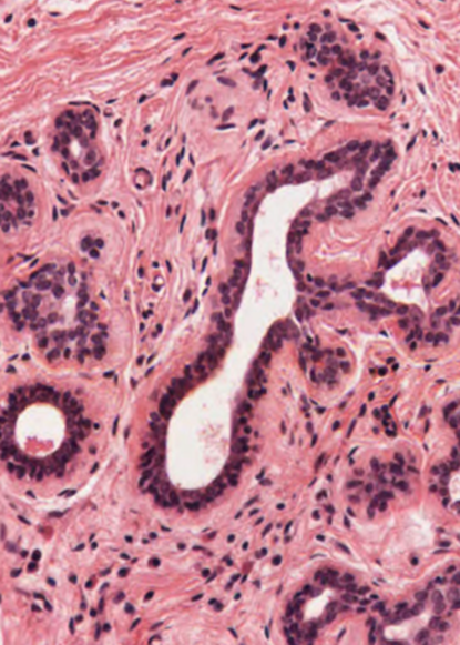 Fig. 2.15. H&E-stained sections of inactive mammary gland. The left one shows paucity of parenchymal lobules (basophilic) and abundance of connective tissue (eosinophilic, pinkish). Higher magnification (right) shows the duct epithelium as bistratified.