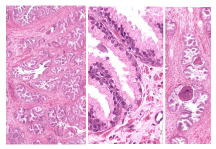 Fig. T14. H&E-stained sections of the prostate. The lower power micrograph (left) shows the general features of the glandular units; the high-power micrograph (middle) shows the secretory glandular epithelial cells as pale columnar cells surrounded by a loose connective containing a few smooth muscle fibers. Two corpora amylacea are seen in the micrograph on the right; they are large dense spherical bodies.
