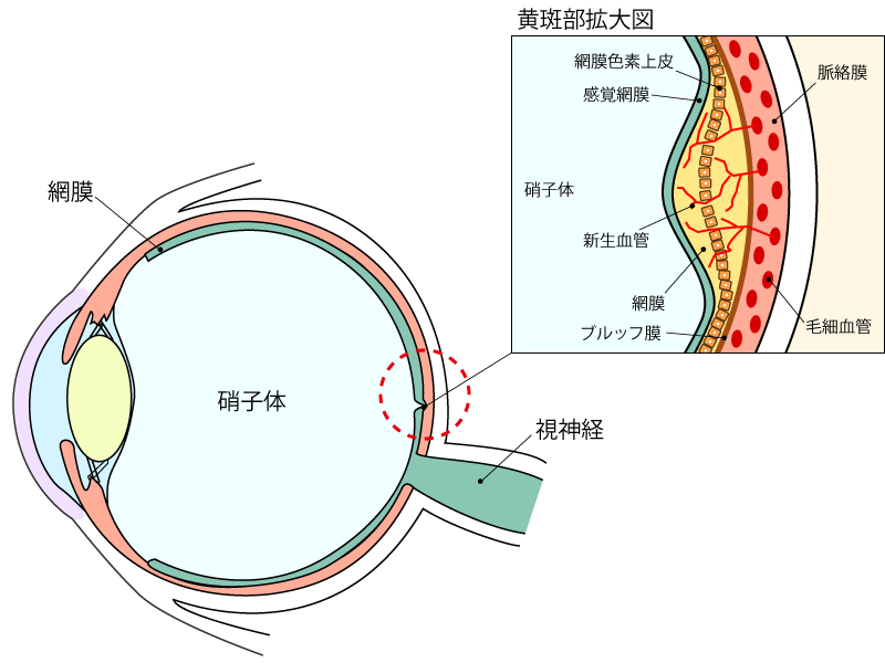 加齢黄斑変性症