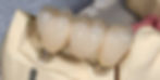 Implant-Supported-Bridge-Model.jpg