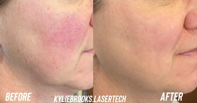 BEFORE AND AFTER IPL REDNESS AND ROSACEA BY KYLIE BROOKS GRAND LEDGE, MI.