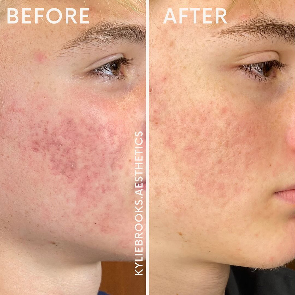 BEFORE AND AFTER SKINPEN MICRONEEDLING ACNE SCARS BY KYLIE BROOKS GRAND LEDGE, MI.