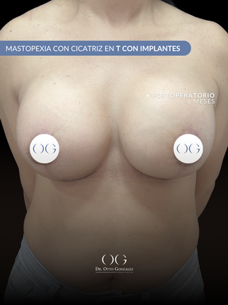 Mastopexia en T con Implantes