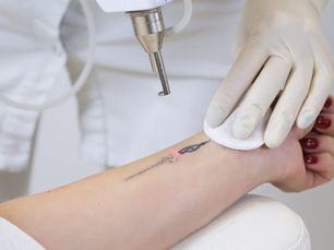 Elimina tu Tatuaje con Tecnología Láser SPECTRA: Seguro, Efectivo y Sin Cicatrices en UNIMEL