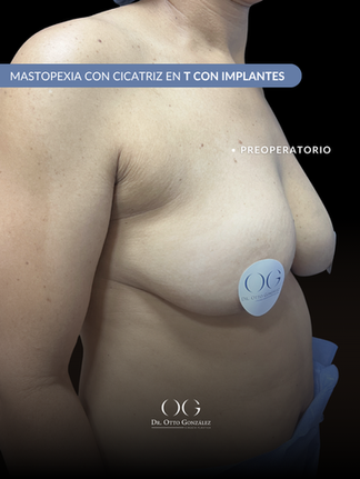 Mastopexia en T con Implantes