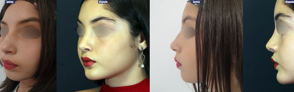 RESULTADO RINOPLASTIA.png