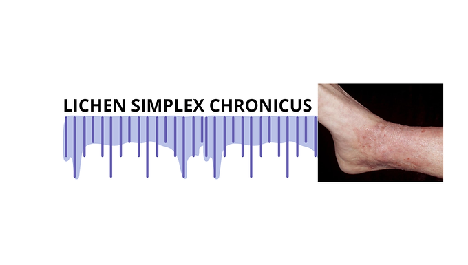 LICHEN SIMPLEX CHRONICUS (NEURODERMATITIS)
