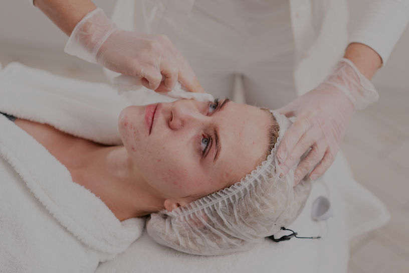 Chemical Peels in Newtownabbey & Carrickfergus
