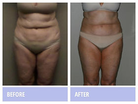 pt141 oral Laser Liposuction Fat Removal Clinic in NYC