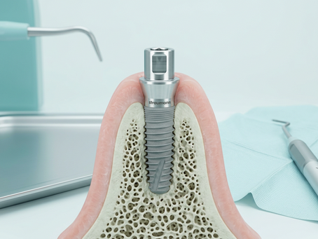 How Dental Implants Enhance Indian Smiles