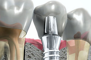 implantologia-dentale1.jpg