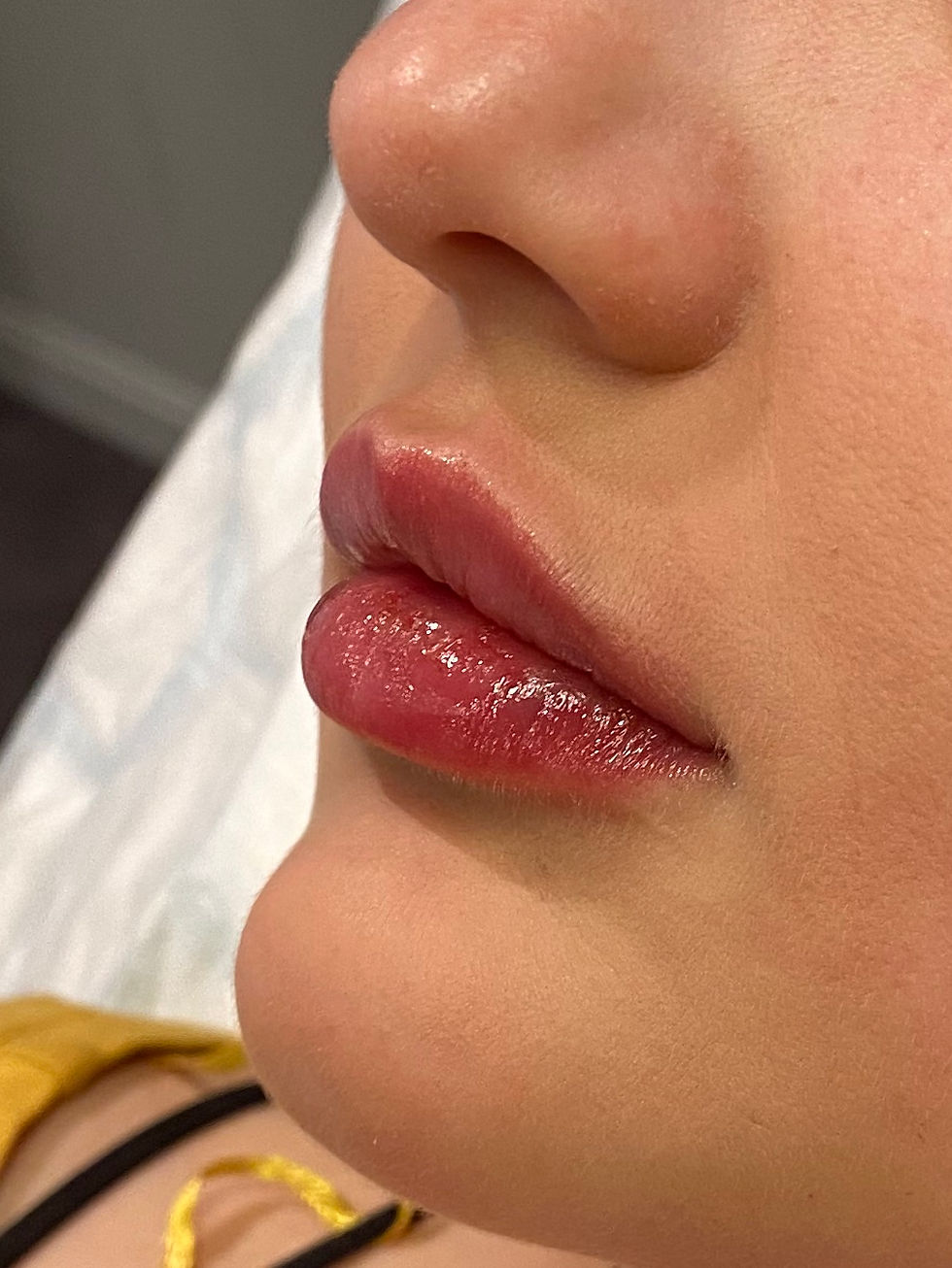 Lip Filler