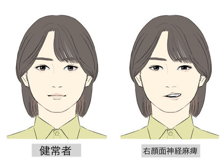 顔面神経麻痺の人