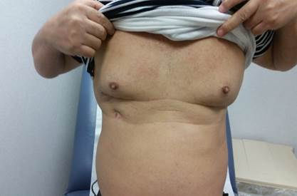 Minimally Invasive Cardiac Surgery applied to Right chest approach for ASD closure