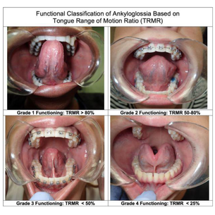 Tongue Trouble: What’s Holding Your Resting Posture Back?