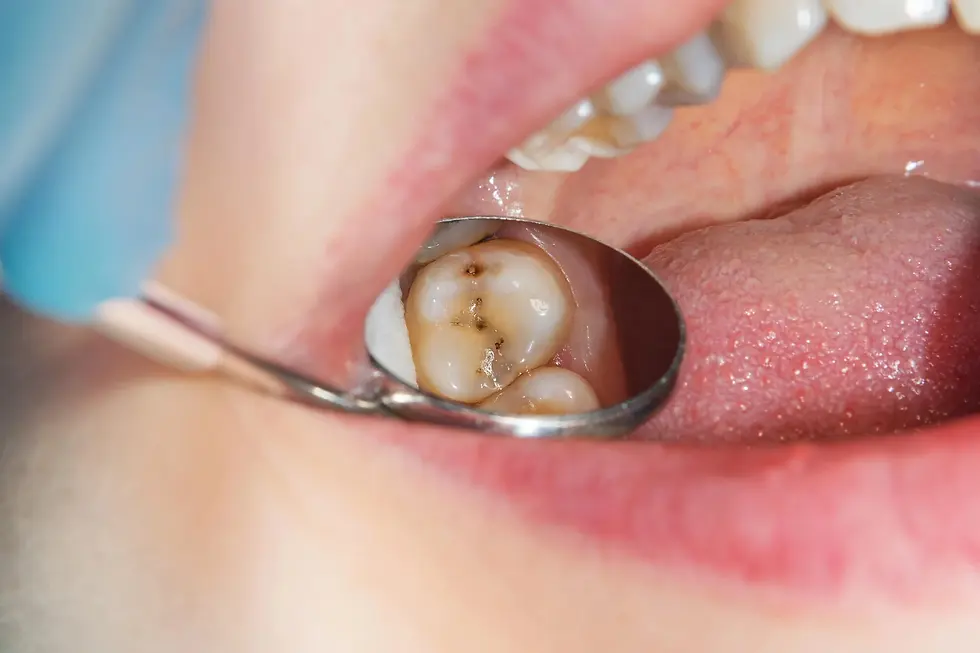 Close-up of a human rotten carious tooth at the treatment stage in the best dentist near K Street.webp