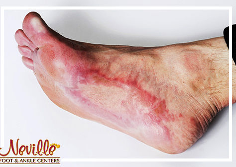 Diabetes identified in the feet first!