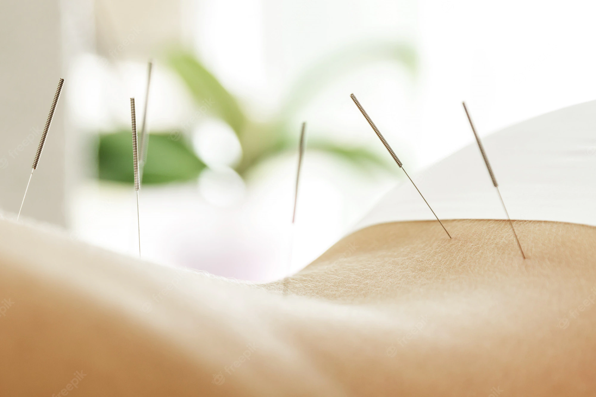 accupuncture.webp
