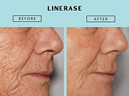 linerase-1.jpg