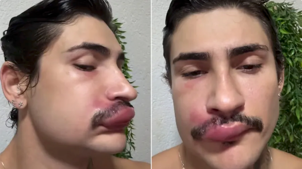 Espremeu uma espinha? O risco pode ser muito maior do que você imagina, alerta caso de influenciador internado