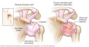 What is a Frozen shoulder?