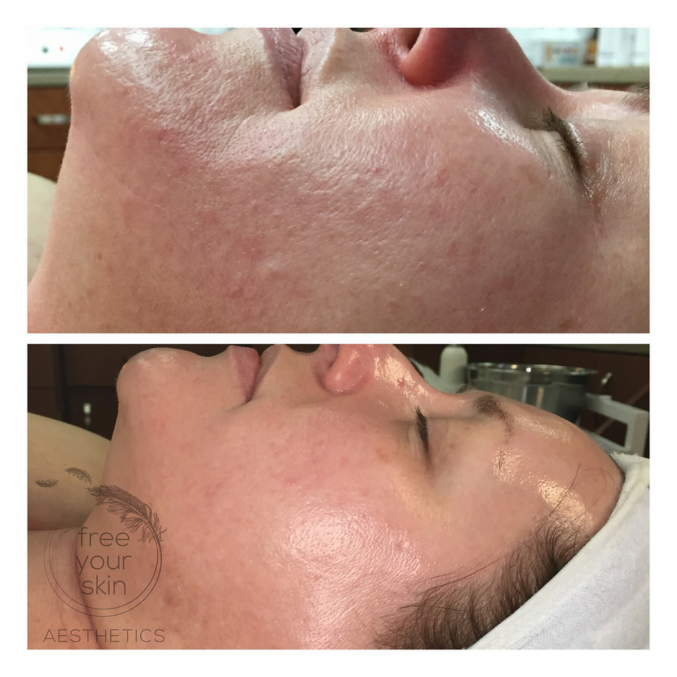 Micro-Needling