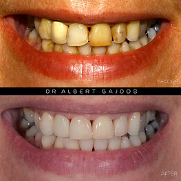 Tooth whitening, Emax porcelain crown, c