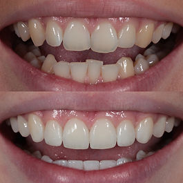 Invisalign and composite bonding for crowding.jpg