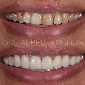 Composite bonding discoloured teeth.jpg