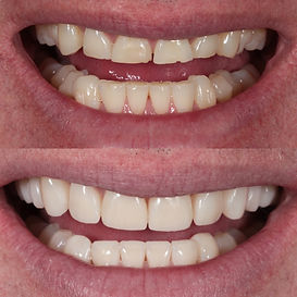 Full upper and lower composite veneers.jpg