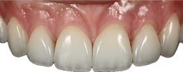 Natural layered composite restorations on upper anterior teeth — Simplifi Composite Layering Course London