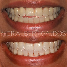 Invisalign provider, tooth whitening smi