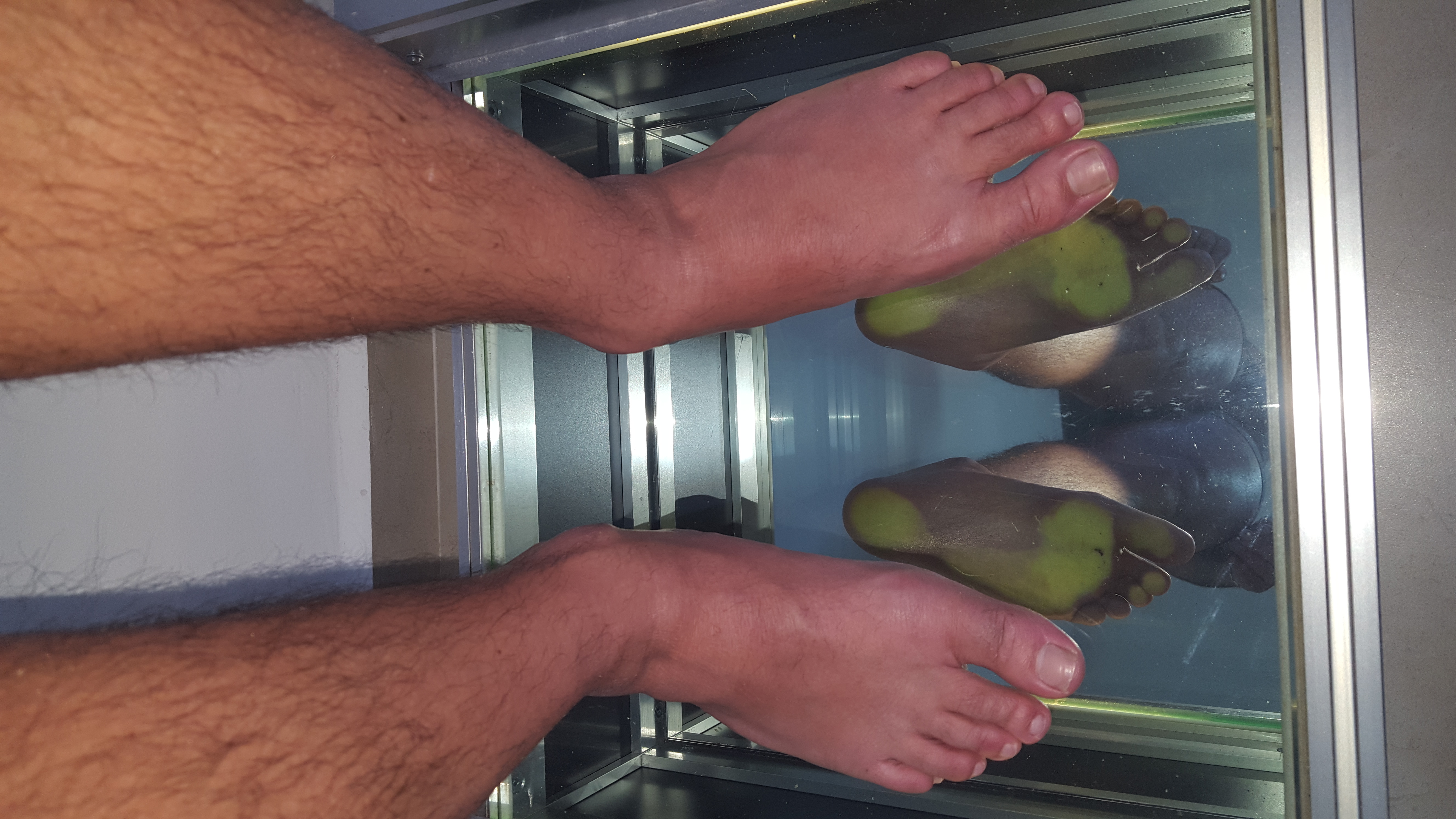 Custom orthotics in Hadera