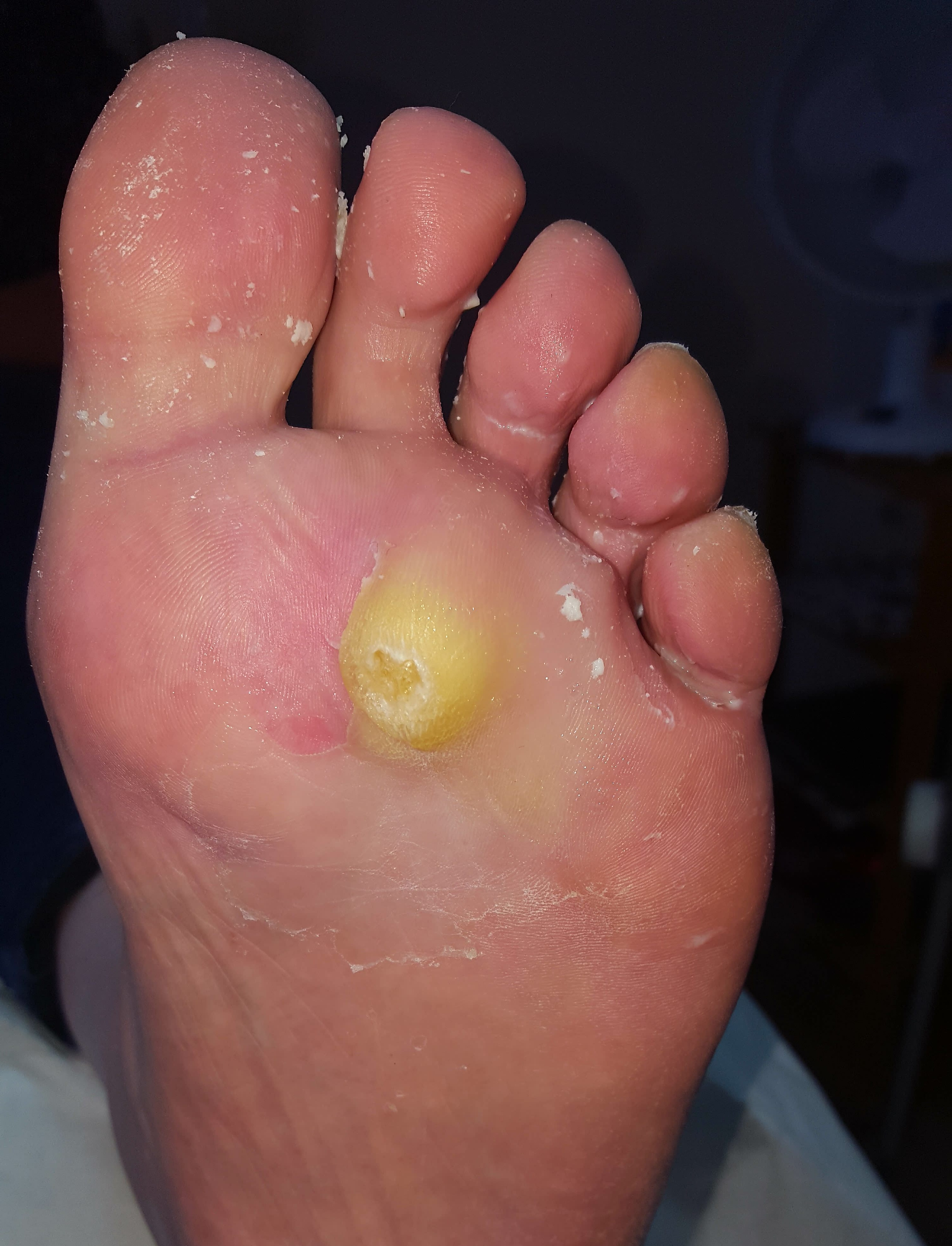 Care for corns and calluses