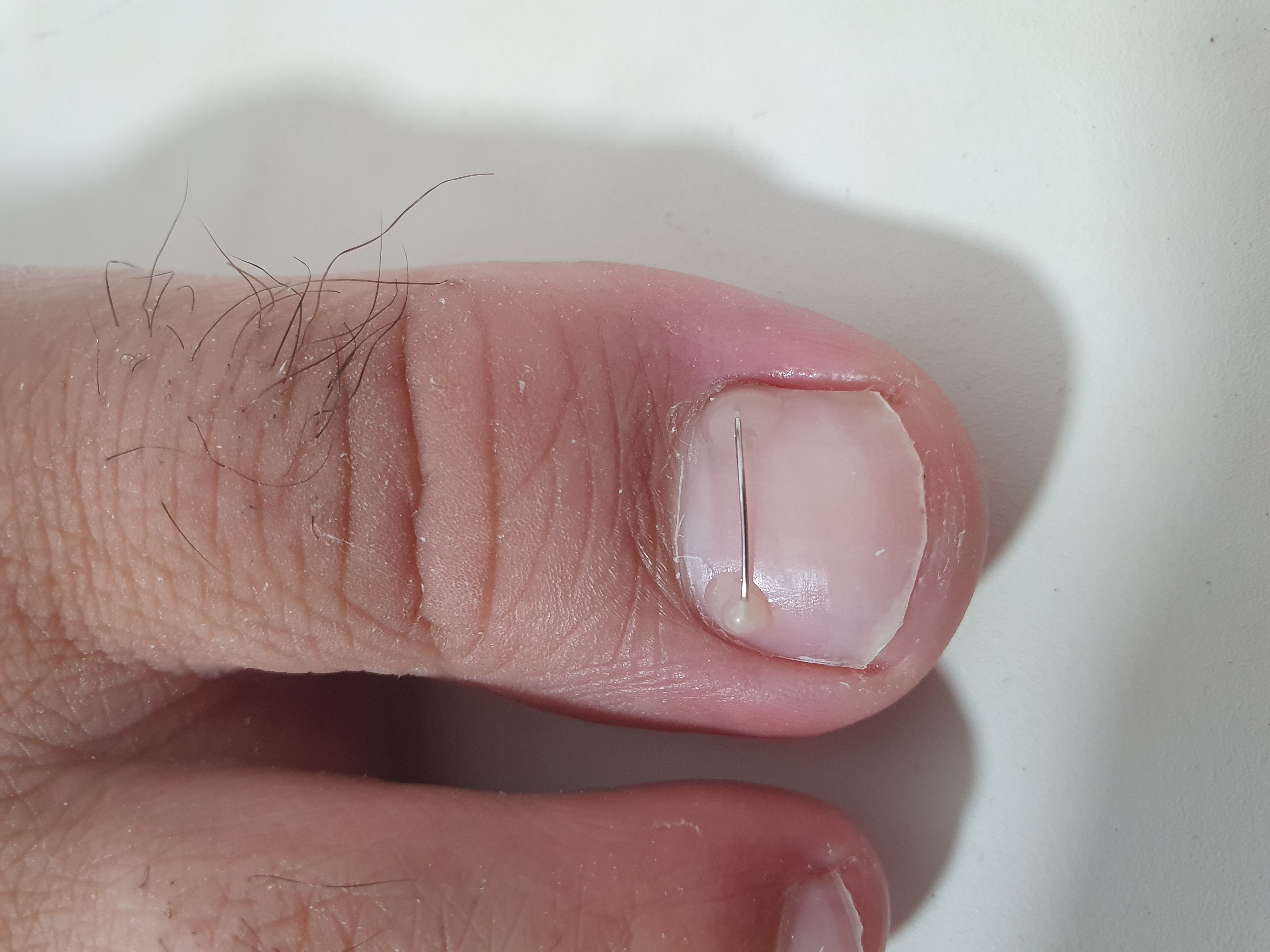 התאמת התקן אורתוניקסיה לציפורן