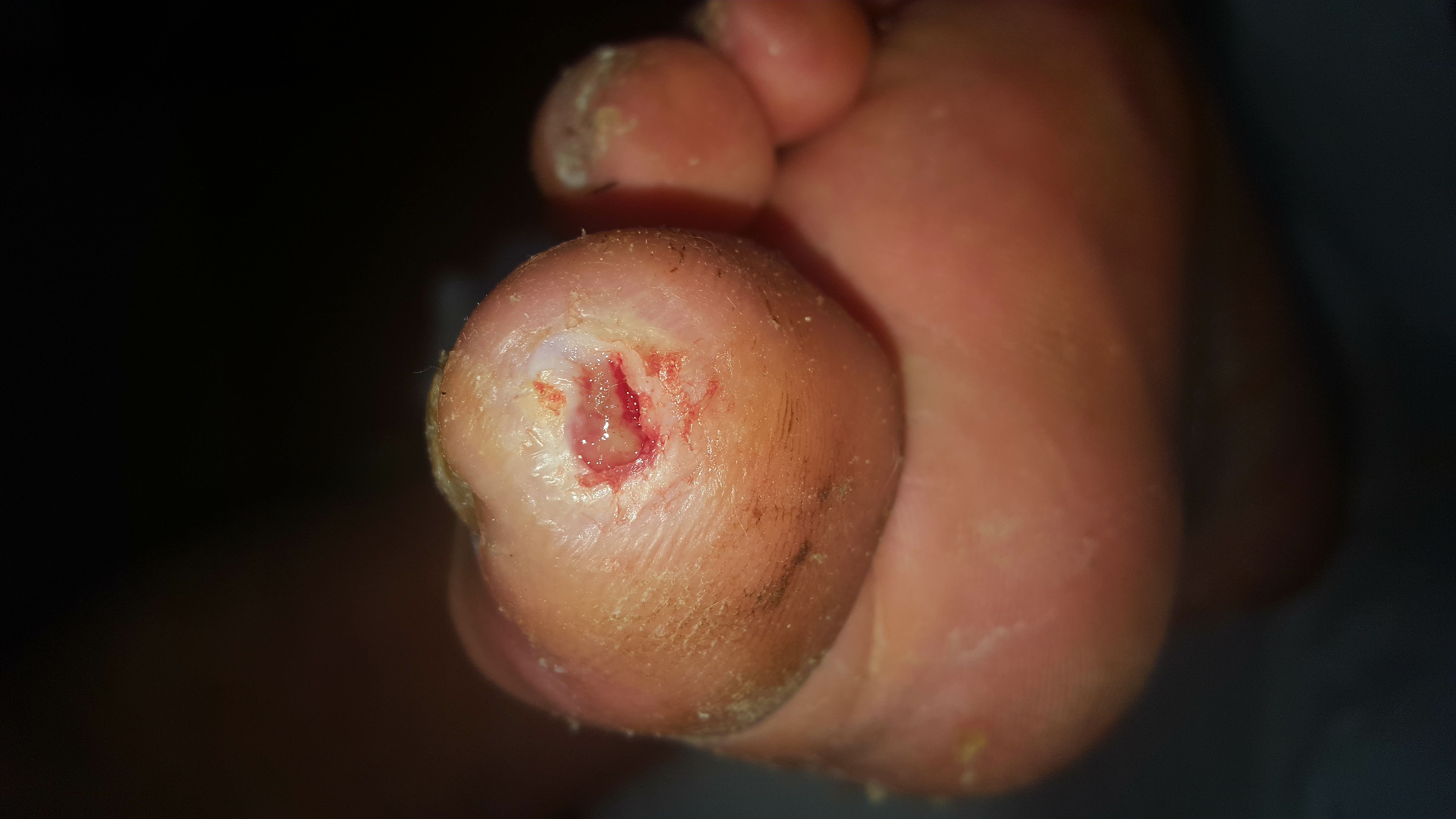 Diabetic foot assessment