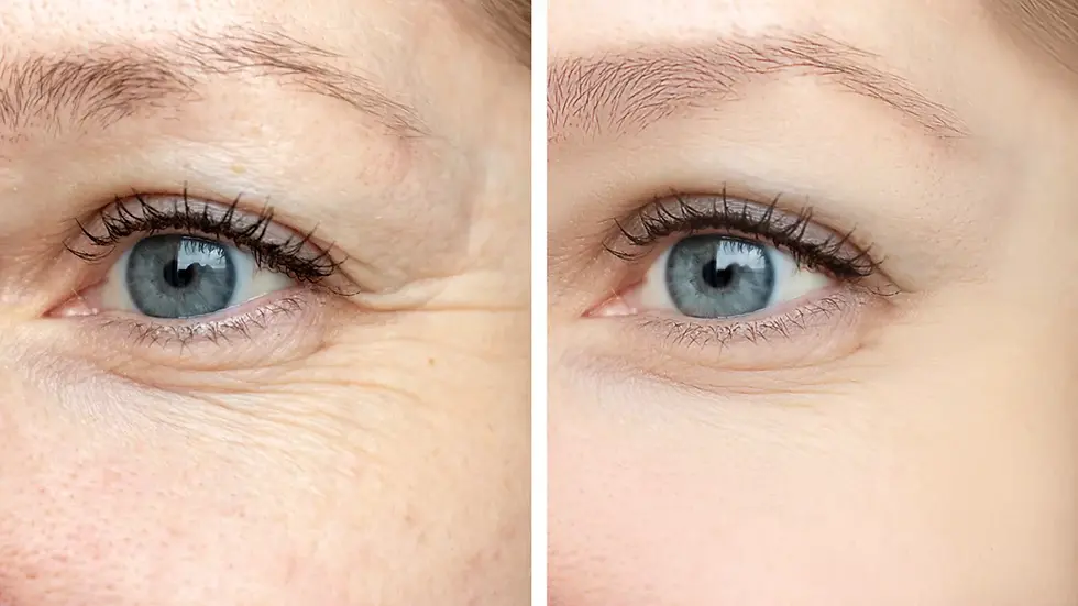 fotona-smootheye-undereye-treatment-ottawa.webp