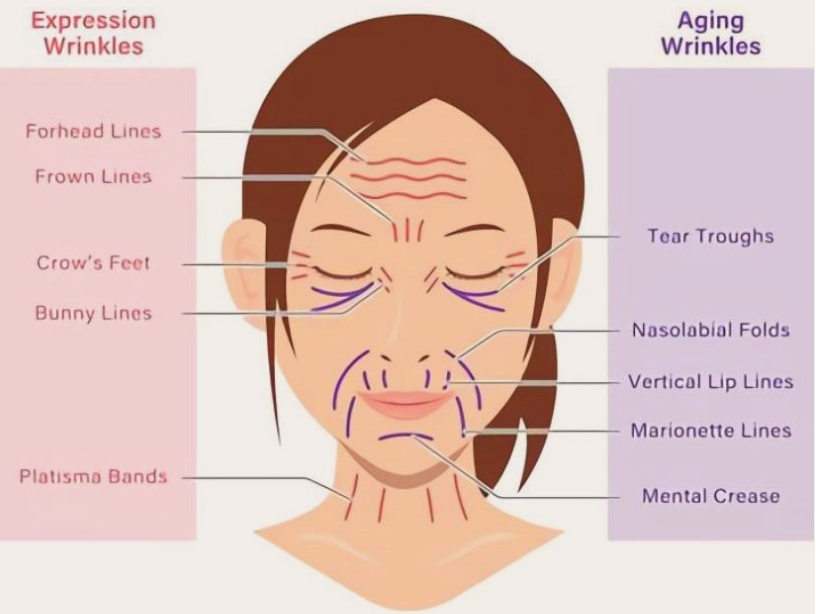 expressopn wrinkles vs aging wrinkles.png