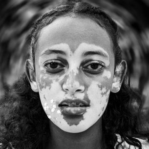 ከነጭ ቆዳዎች በስተጀርባ ፡ የለምጽ እጣ በኢትዮጵያ