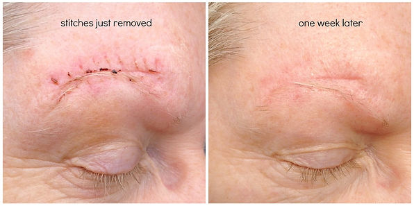 luminesce szérummal szépen gyógyulnak a hegek